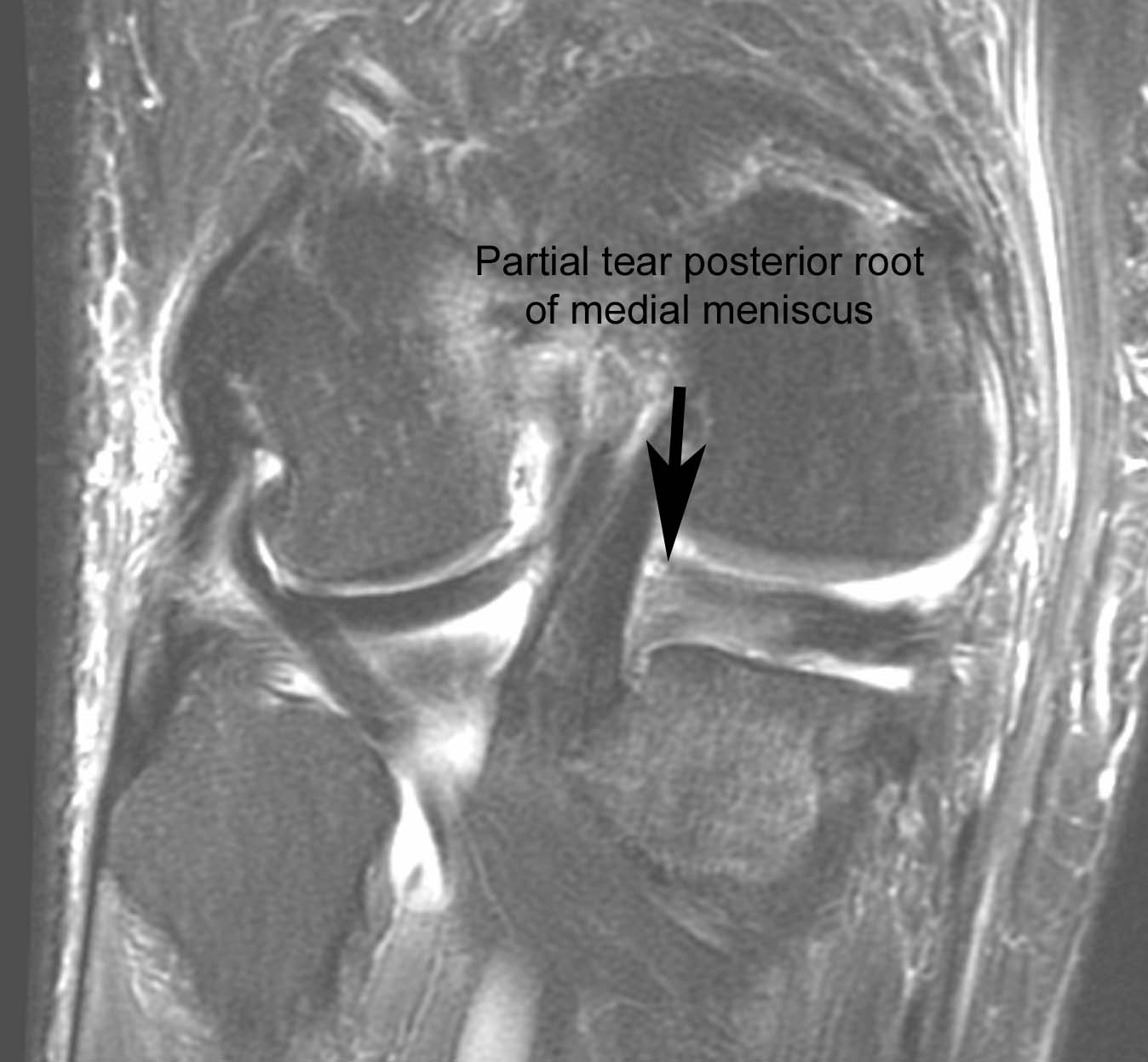 Figure 5 for case Disrupted ACL graft